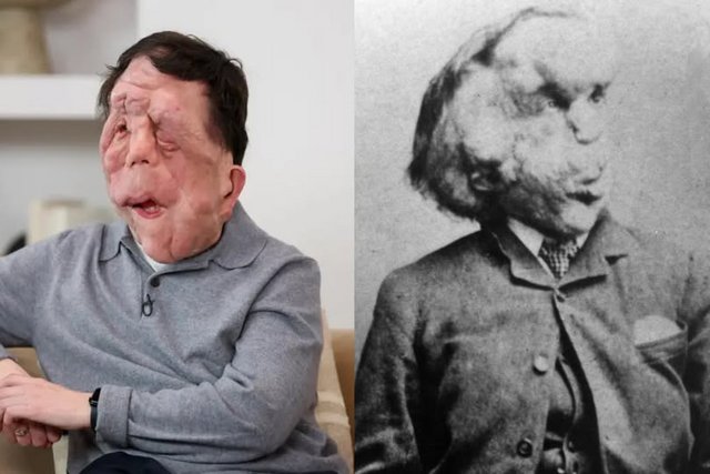 Νέα διασκευή στον «Άνθρωπο Ελέφαντα», ο Άνταμ Πίρσον πρωταγωνιστεί, ο Όλιβερ Χιρσμπίγκελ σκηνοθετεί